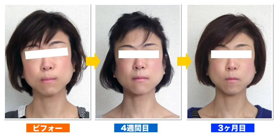 調布と府中の小顔矯正の症例写真