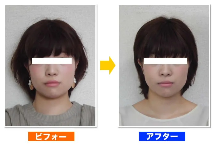 府中・調布の小顔・顔の歪みが改善した症例