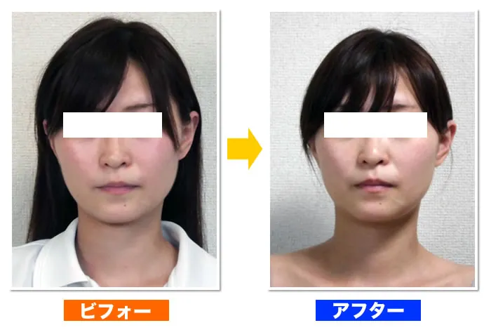 府中・調布の顔の歪み矯正のビフォーアフター